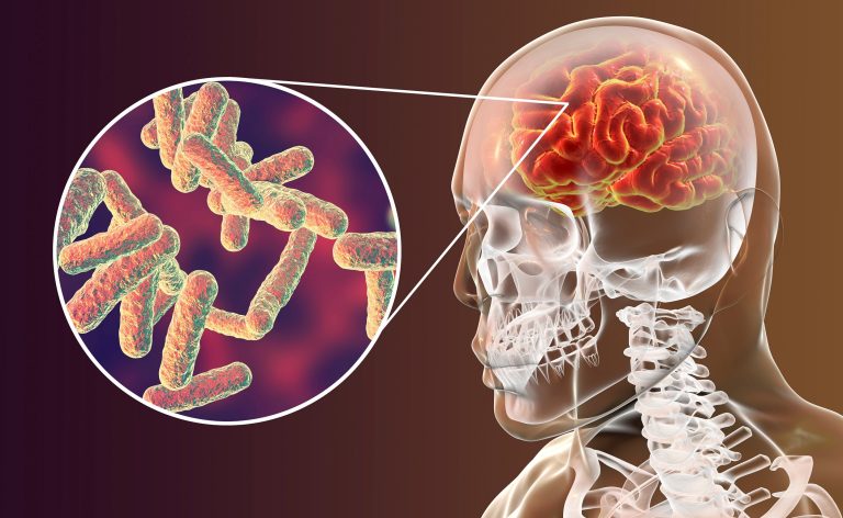 Casos de meningite em Goiás preocupam autoridades de saúde após registro de mortes e baixa vacinação. Entenda os riscos, sintomas e a importância da imunização.